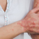 Artrita psoriazica